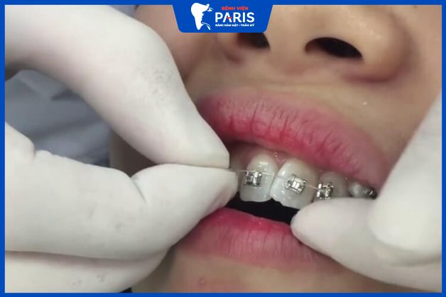 Bác sĩ gắn mắc cài, dây cung lên cung hàm