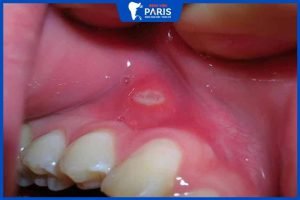 Nướu răng có đốm trắng do đâu? Nên xử lý như thế nào mới tốt?
