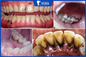 Răng bị đen do đâu? Cần khắc phục như thế nào mới hiệu quả?