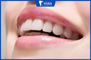 Răng hơi hô cười sao cho đẹp? – 2 giải pháp khắc phục răng hô
