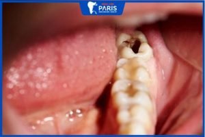Răng khôn bị sâu có nhổ bỏ được không? Chi phí hết khoảng bao nhiêu?