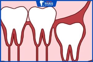 Răng khôn mọc thẳng có nên nhổ không? Khi nào thì nên nhổ?