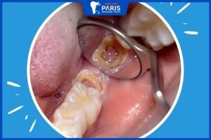 Răng sâu bị vỡ chỉ còn chân răng: Biến chứng và cách xử lý hiệu quả