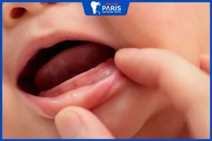 Sưng lợi mọc răng ở trẻ: 6 Cách nhận biết và giảm bớt sự khó chịu