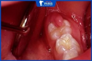 Sưng nướu răng hàm dưới: Nguyên nhân và cách chữa trị