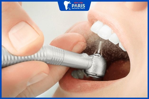 Lấy cao răng giúp loại bỏ mảng bám