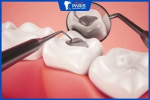 4 Nguyên nhân khiếnTrám răng bị ê buốt kéo dài