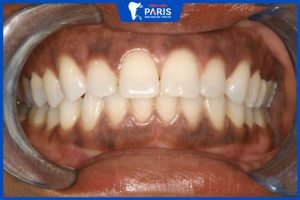 Tại sao làm răng sứ bị thâm nướu? Ảnh hưởng và cách giải quyết