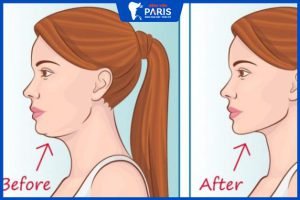 Tập Mewing đúng cách: 2 phương pháp và 3 lỗi sai cần tránh