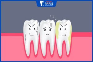 8 Dấu hiệu viêm chân răng- 4 Cách phòng tránh hiệu quả
