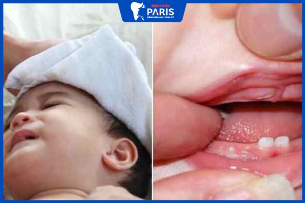 Trẻ sốt mọc răng với sốt thông thường khác gì nhau?