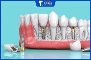 Trồng răng implant có nguy hiểm không? – 6 biến chứng có thể xảy ra