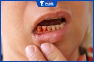 6 mẹo chữa viêm lợi chảy máu chân răng mà bạn cần biết