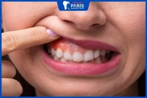 Viêm nướu răng ở người lớn: dấu hiệu, biến chứng, cách điều trị