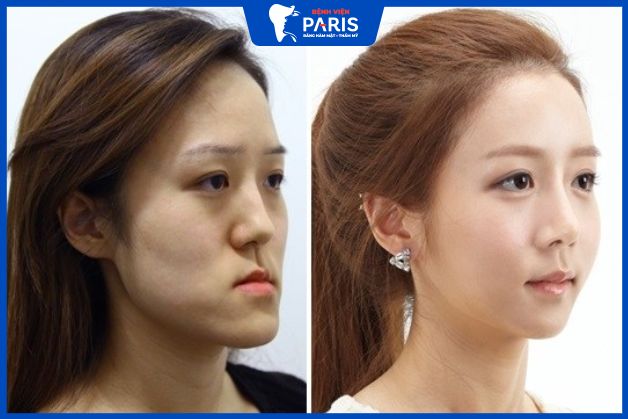 Kĩ thuật gọt mặt lưỡi cày khắc phục hoàn toàn sự sai lệch trong khớp cắn hàm dưới