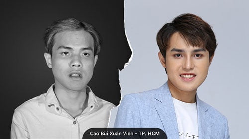 Mặt bị lệch