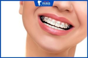 Có niềng răng 1 hàm được không- 4 Trường hợp cần niềng