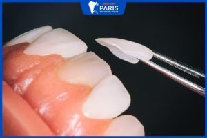 Dán răng sứ veneer có tốt không? 3 Ưu điểm lớn của răng sứ
