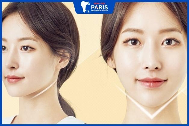 Độn cằm không phẫu thuật giá bao nhiêu: 3 lưu ý quan trọng