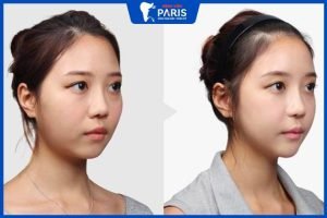 Độn trán ở đâu đẹp – 4 Tiêu chí lựa chọn quan trọng cần biết