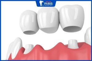 Giải đáp: Trồng răng bắc cầu có tốt không, 4 Loại răng sứ tốt