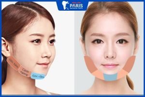 Hỏi – Đáp: Phẫu thuật cắt xương hàm có nguy hiểm không?