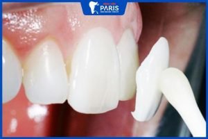 Tổng hợp 4 kinh nghiệm dán răng sứ veneer bạn không thể bỏ qua