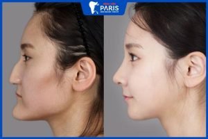 6 Kinh nghiệm phẫu thuật hàm móm: 4 Điều cần biết trước phẫu thuật