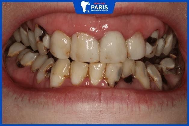 Răng nanh bị sâu nặng nên được nhổ bỏ