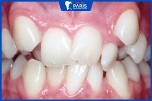 Nhổ răng nanh có nguy hiểm không? – 3 trường hợp cần nhổ bỏ