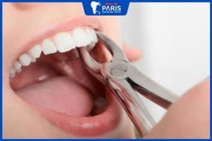 Nhổ răng sau bao lâu thì ăn được? 5 món nên ăn và nên kiêng
