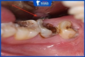 Giải đáp thắc mắc: Nhổ răng sâu có nguy hiểm không?