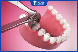 Nhổ răng số 6 bao lâu thì trồng lại được – 3 yếu tố ảnh hưởng