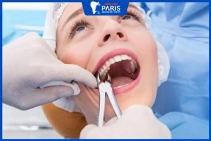 Nhổ răng số 7 bao lâu thì trồng lại được: 3 Cách giảm thời gian