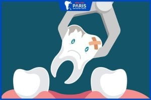 Nhổ răng số 7 có ảnh hưởng thần kinh không, 5 vấn đề có thể gặp