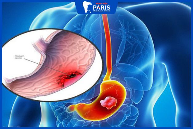 Mất răng gián tiếp gây nên bệnh viêm dạ dày