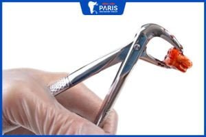 Nhổ răng số 7 có nguy hiểm không? 3 lưu ý khi chọn địa điểm