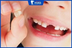 Nhổ răng sữa bao lâu mọc lại – 5 Dấu hiệu khiến răng mọc chậm