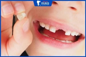 Nhổ răng sữa chưa lung lay có đau không? – 4 tips giảm đau