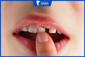 Nhổ răng sữa có nguy hiểm không? Cách nhổ răng sữa an toàn