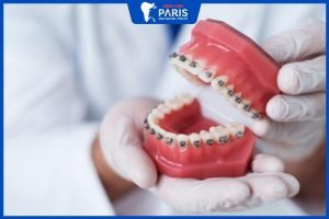 Niềng răng bao lâu thì răng bắt đầu dịch chuyển – 8 Yếu tố quan trọng