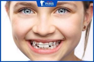 Niềng răng cho trẻ em có đau không – 5 Vấn đề cần lưu ý