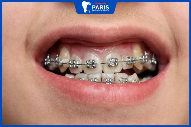 Niềng răng có phải nhổ răng khểnh không - trường hợp không phải nhổ
