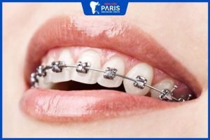 Niềng răng hàm trên có được không – 2 phương pháp phổ biến