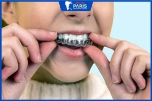 Niềng răng Invisalign có phải nhổ răng không? Ai cần phải nhổ?