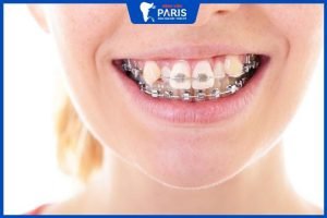Niềng răng khấp khểnh mất bao lâu – 3 Yếu tố quyết định đến