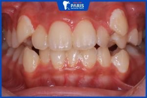 Niềng răng khểnh có đau không – 4 Cách giảm đau hiệu quả