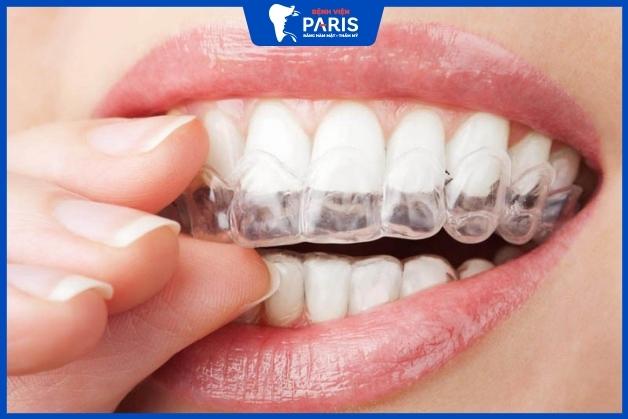 Niềng răng khểnh Invisalign