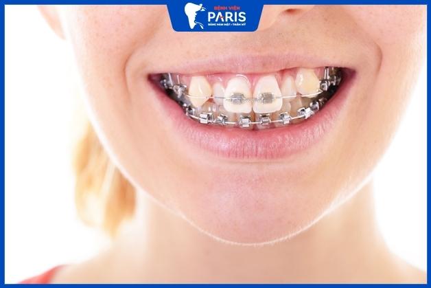 Niềng răng khểnh mất bao lâu