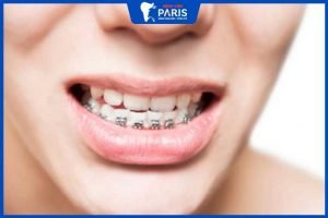 Niềng răng khớp cắn ngược bao lâu – 3 lưu ý khi chỉnh nha